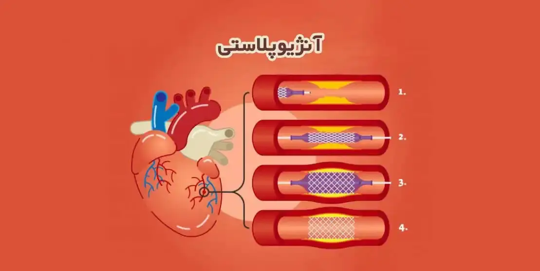 آنژیوپلاستی چیست؟ - نبض هوشمند سلامت